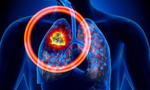 Điều trị ung thư phổi 1, 2, 3, 4 như thế nào cho hiệu quả