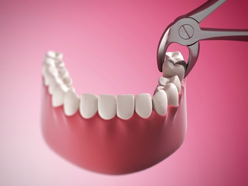 Niềng răng cần nhổ những răng nào? Nhổ bao nhiêu răng?