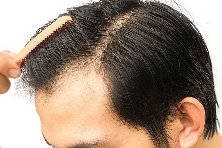 Cấy tóc tự thân FUT – Ưu và nhược điểm