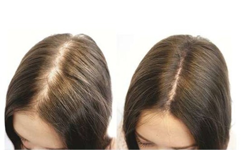 Thời gian thực hiện và phục hồi của cấy tóc FUE và FUT